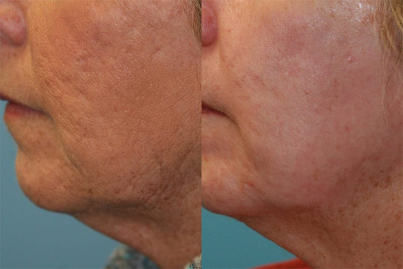 co2-laser-resurfacing-01-fox-facial-plastic-surgery-center