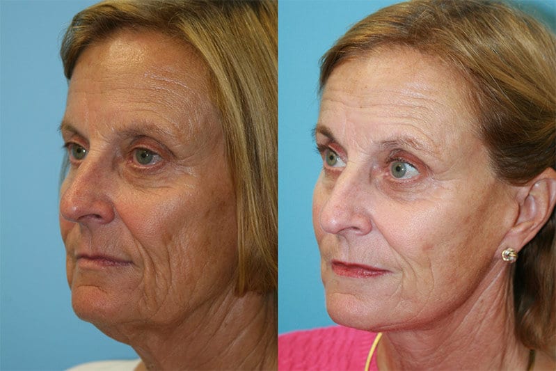 Facelift 02 - Fox Facial Plastic Surgery Center