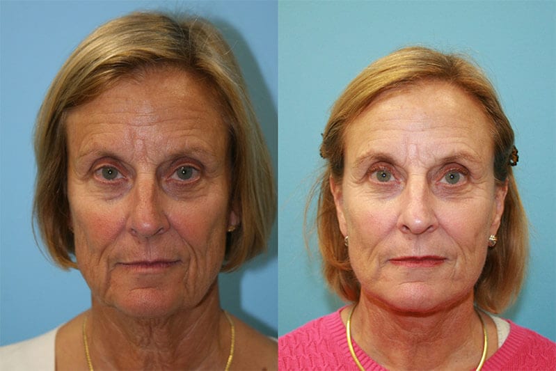 Facelift 02 - Fox Facial Plastic Surgery Center