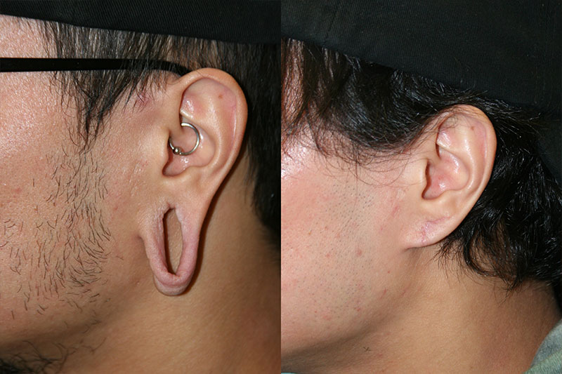 Gauged Earlobe Repair 03 Fox Facial Plastic Surgery Center 6920