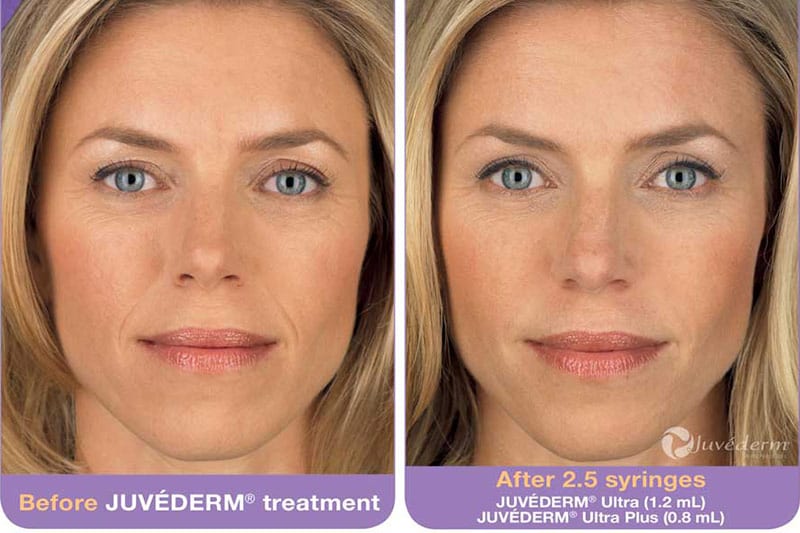 JUVÉDERM® Archives - Fox Facial Plastic Surgery Center