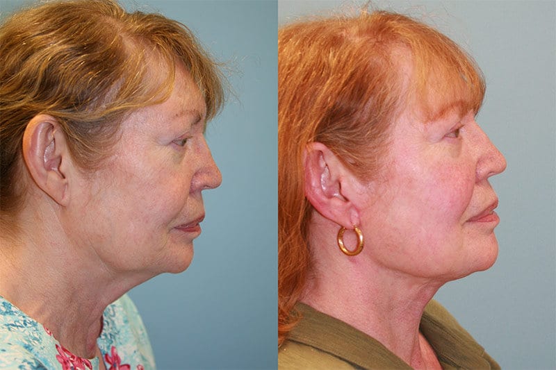 Neck Lift 02 - Fox Facial Plastic Surgery Center