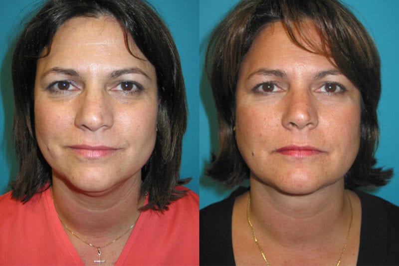 Neck Lift Archives - Fox Facial Plastic Surgery Center