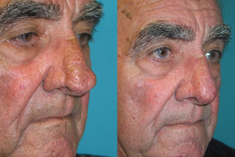 Rhinophyma 04 - Fox Facial Plastic Surgery Center